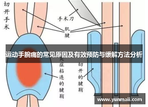 运动手腕痛的常见原因及有效预防与缓解方法分析